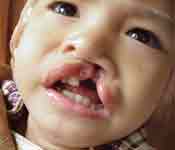 KeyKidFoundation.org, free surgery on cleft paletes, Facial Surgery Projects