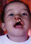 Key Kid Foundation .org, fix Cleft Palate on children